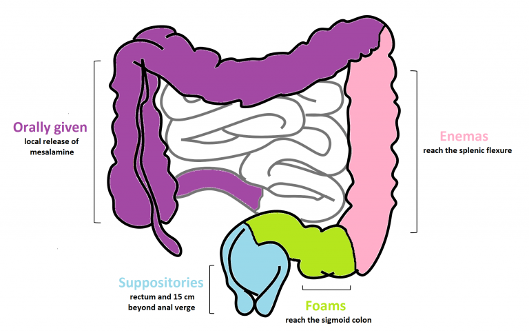 IBD Basics: Aminosalicylates - 5ASAs • Young Crohns